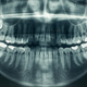 Image for article titled Dental X-rays linked to the most common type of brain tumor